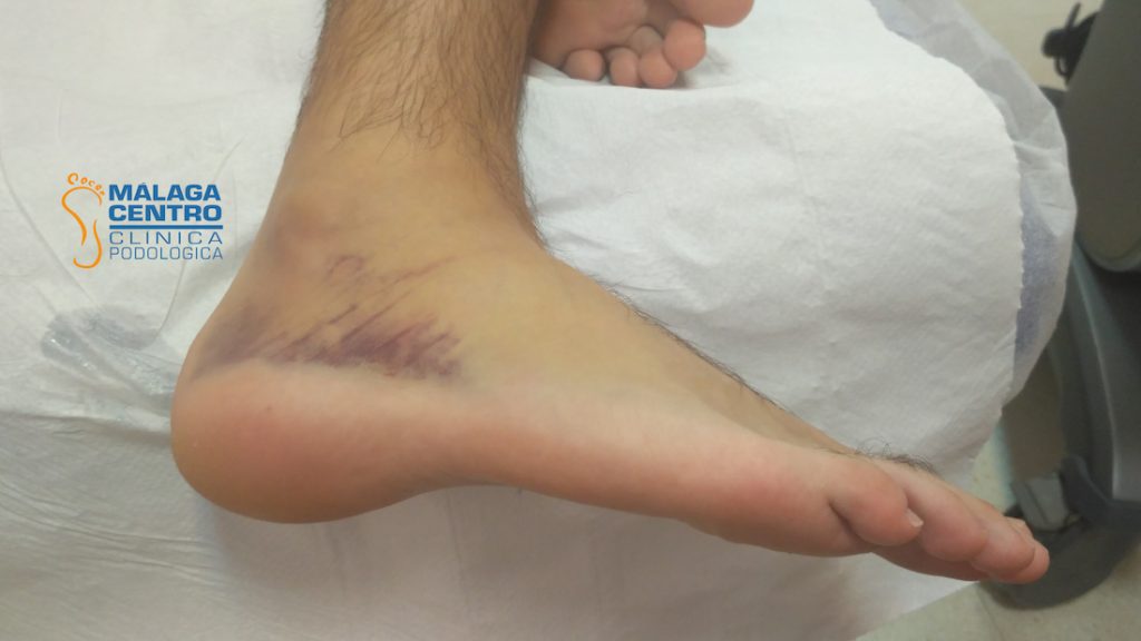 Esguince de tobillo Casos reales de nuestra clínica de podología y fisioterapia en Málaga Esguince de tobillo Casos reales de nuestra clínica de podología y fisioterapia en Málaga